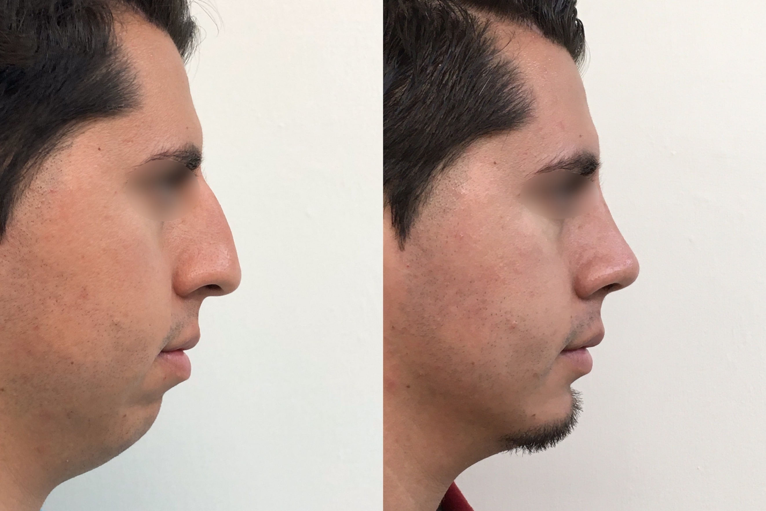 mentoplastia Paciente2