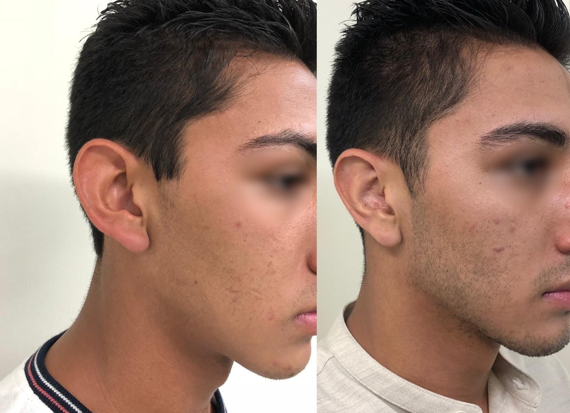 Collage Antes y Después