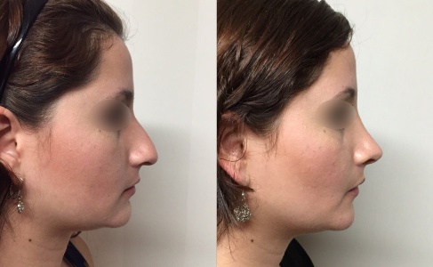 Collage Antes y después