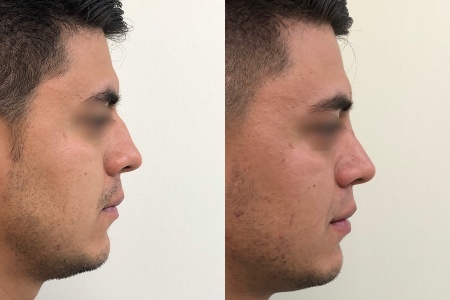 Collage Antes y Después