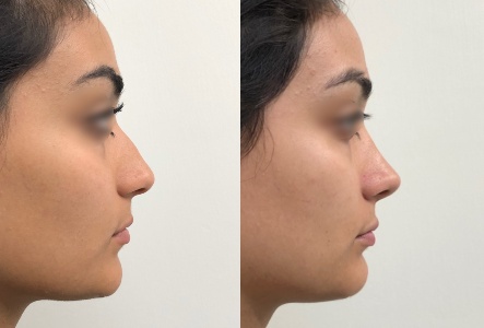 Collage Antes y después