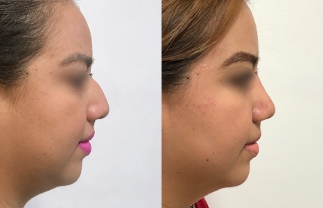 Collage Antes y después