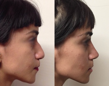 Collage Antes y después