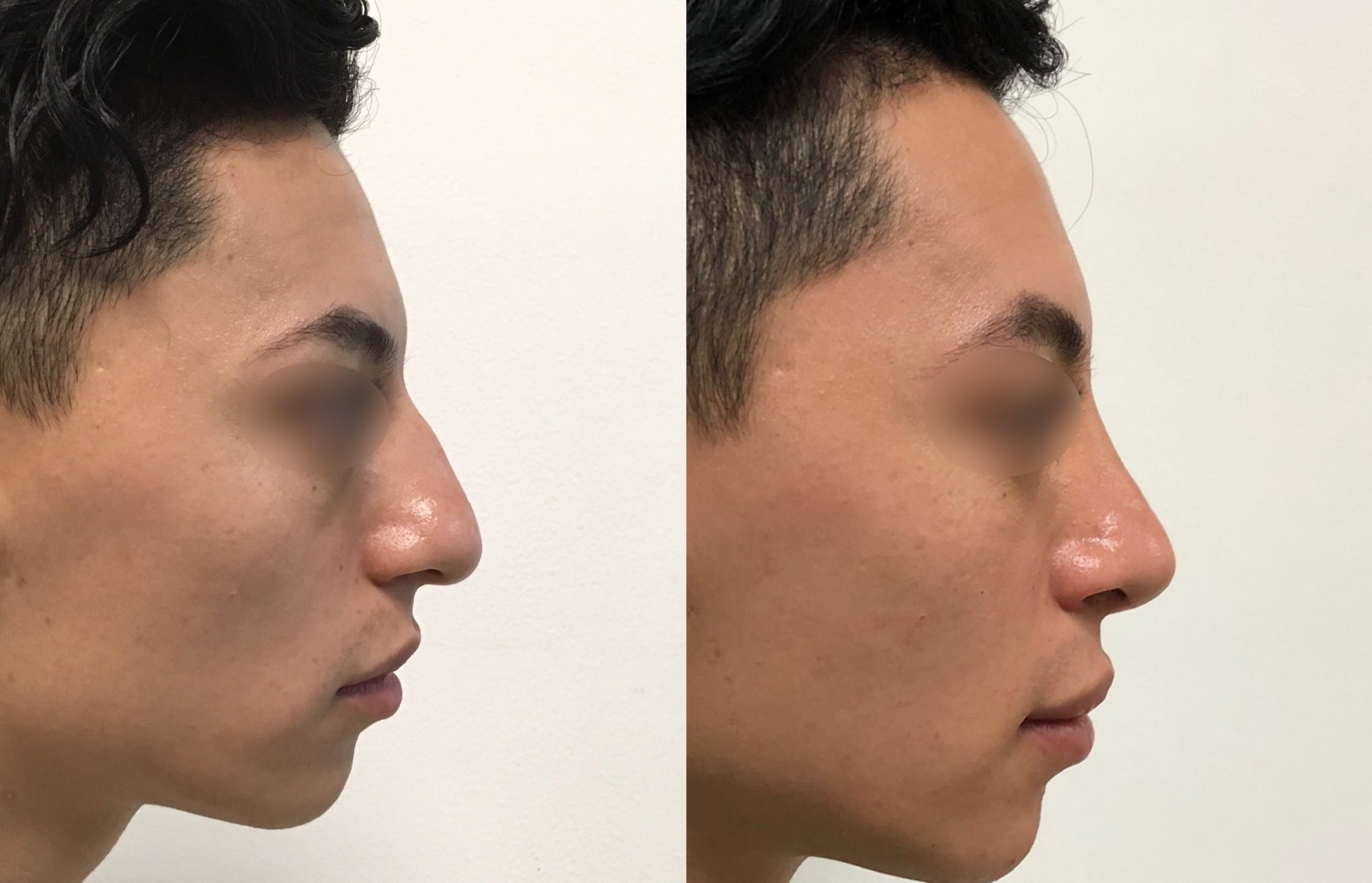 Collage Antes y después