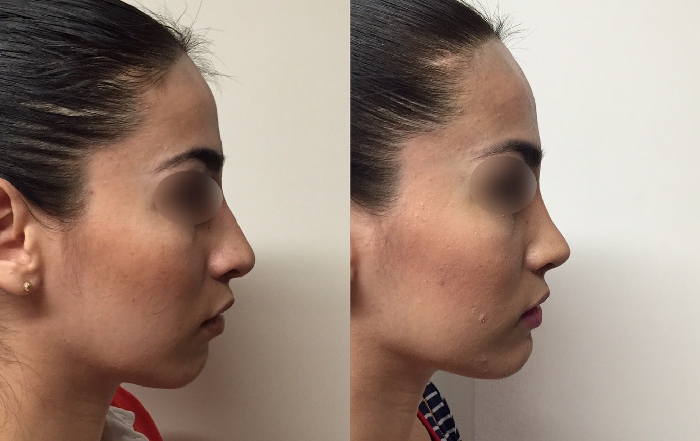 Collage Antes y Después