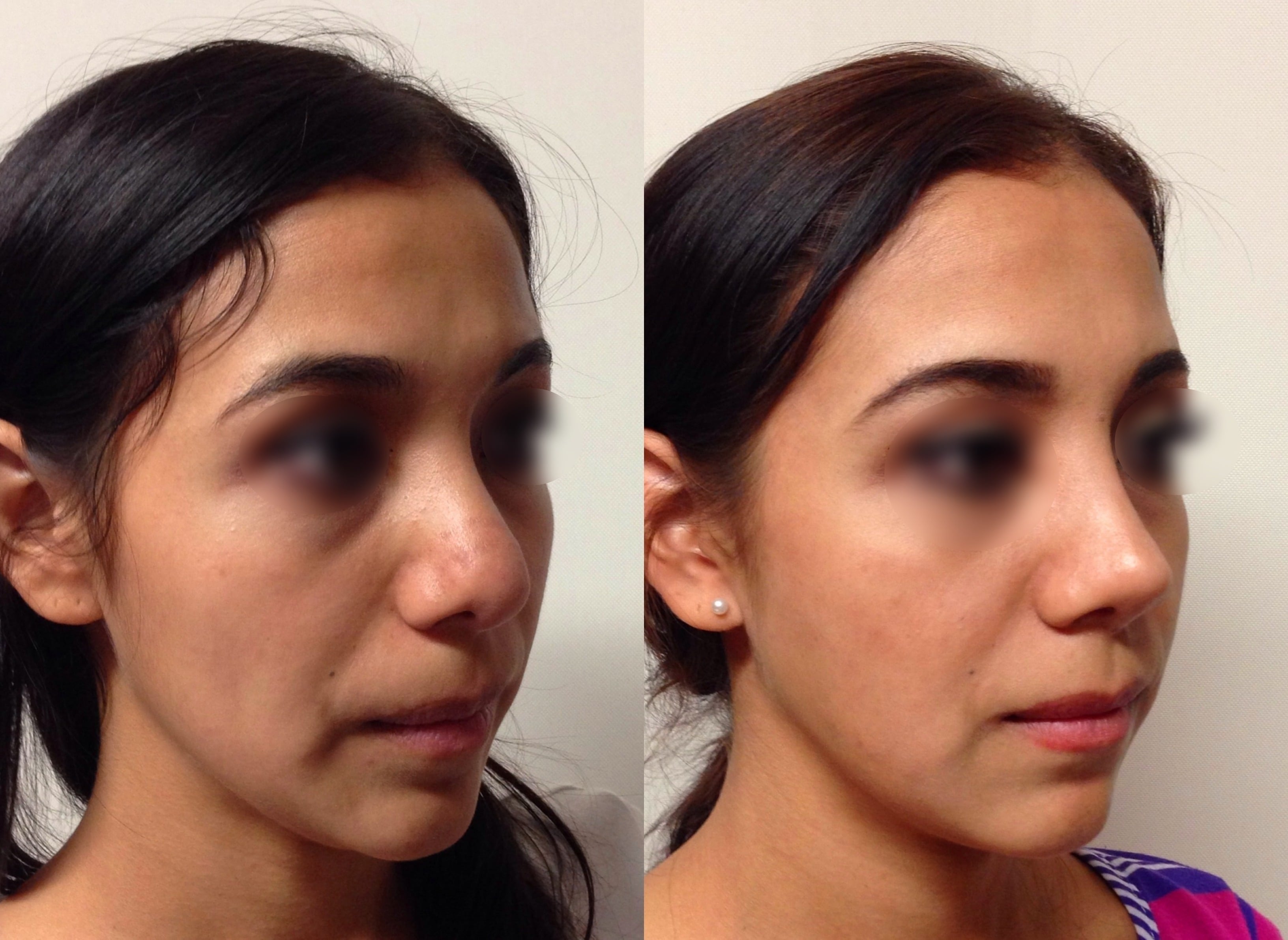 Collage Antes y después