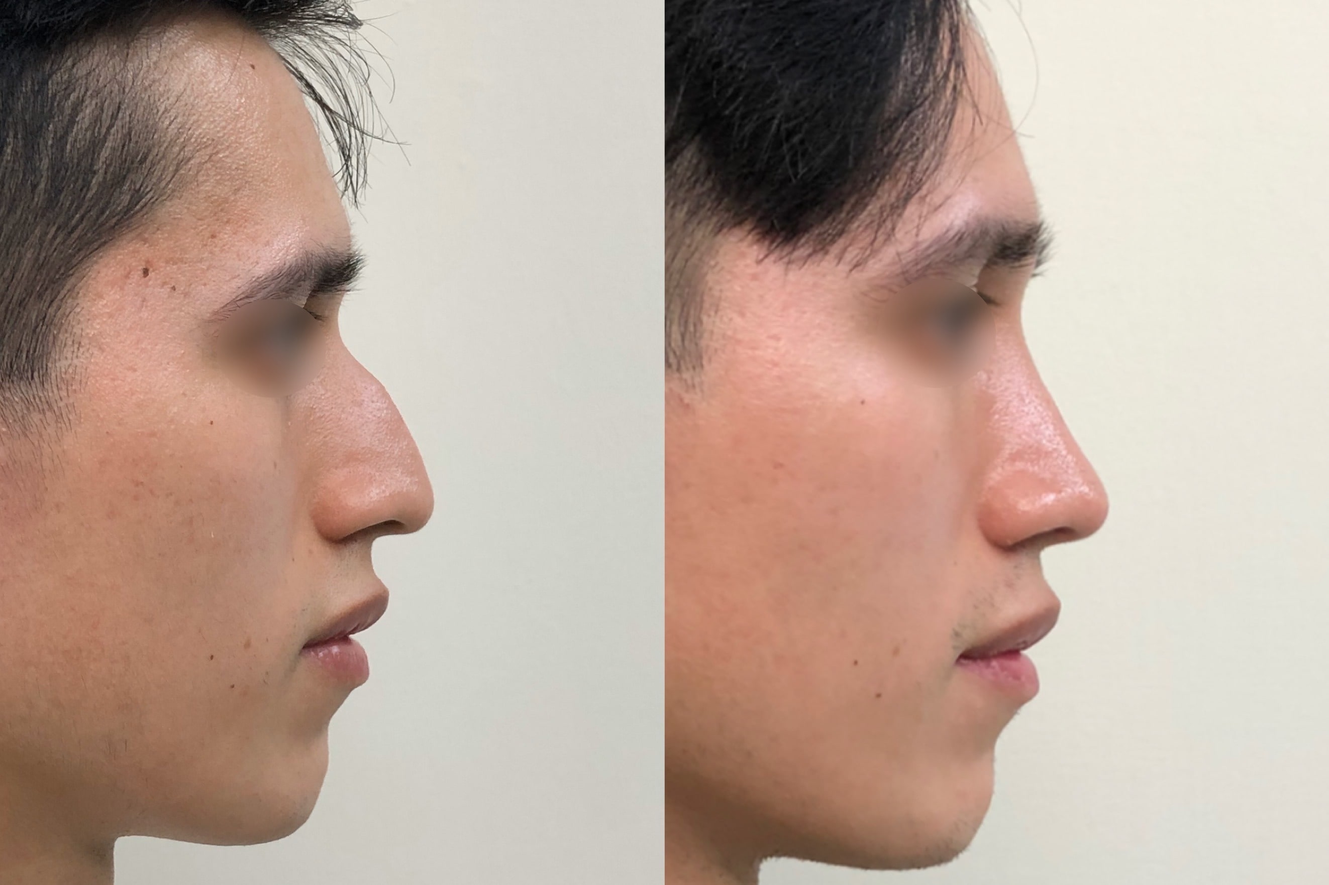 Collage Antes y después